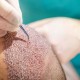 Kmax Zestaw Pielęgnacyjny po Przeszczepie i Transplantacji Włosów 4-produkty