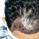Szampon Oczyszczający po przeszczepie włosów Kmax 100ml Przeszczep Włosów